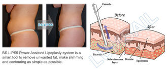 3 σε 1 χειρουργική κενή μηχανή δημιουργίας κοιλότητας Liposuction/τον παχύ εξοπλισμό μείωσης