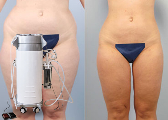 Διαμόρφωση λεπτής μηχανής Lipo μηχανών Liposuction σώματος της χειρουργικής για το πηγούνι/τους εξωτερικούς μηρούς
