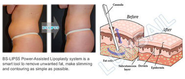 Σώμα που διαμορφώνει lipolysis liposuction μηχανών τη μηχανή δημιουργίας κοιλότητας