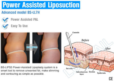 Διαμόρφωση λεπτής μηχανής Lipo μηχανών Liposuction σώματος της χειρουργικής για το πηγούνι/τους εξωτερικούς μηρούς