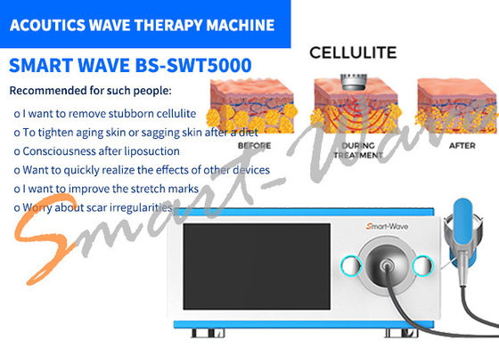 6 μηχανή θεραπείας ακουστικών κυμάτων συσκευών αποστολής σημάτων για την αφαίρεση σημαδιών τεντωμάτων/την αναδιαμόρφωση σώματος