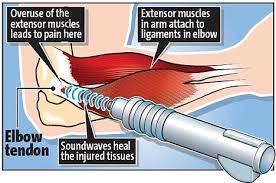 Shockwave ESWT θεραπείας αγκώνων αντισφαίρισης Smartwave θεραπεία equipment ondas de choque κρουστικών κυμάτων ανακούφισης πόνου